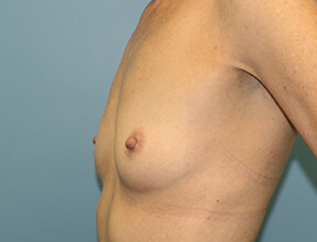 implant exchane before