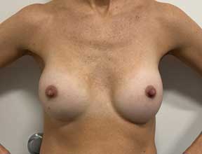 breast implant exchange after