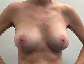 breast implant exchange after
