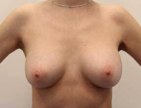 breast implant exchange after