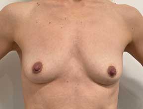 breast implant removal after