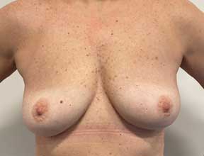 breast implant removal after