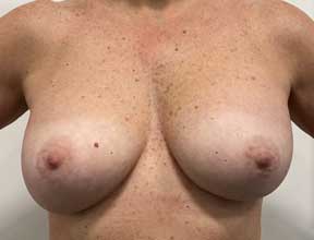 breast implant removal before