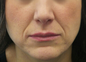 Botox Before