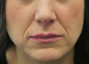 juvederm before