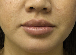 juvederm after