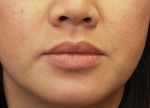 juvederm before