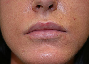 juvederm after