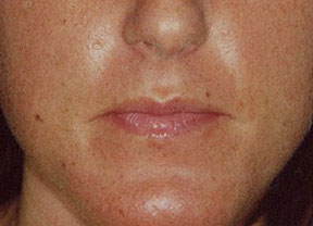 juvederm before