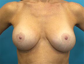 Breast Lift After