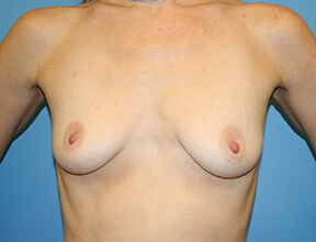 Breast Lift Before