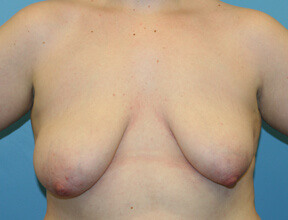 Breast Lift Before