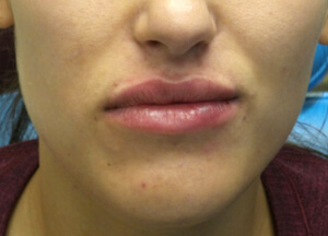 juvederm lips after