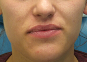 juvederm lips before