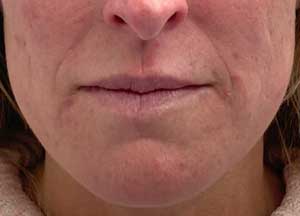 Lip Filler Before