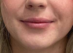 Lip Filler After