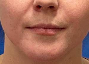 Lip Filler Before