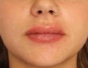 RHA Redensity Lips After