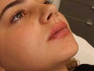 RHA Redensity Lips After