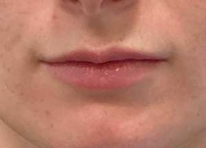 Lip Filler Before