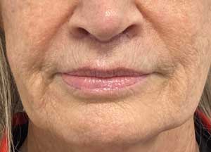 Lip Lift After