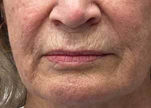 Lip Lift Before