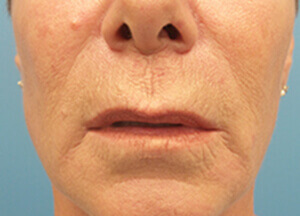 Lip Lift Before