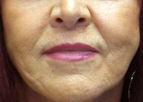 Lip Lift After