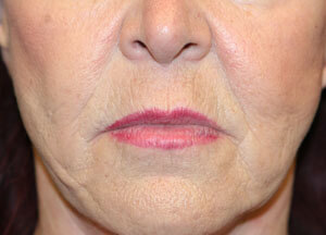 Lip Lift Before
