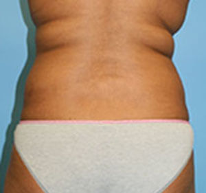 lipo before