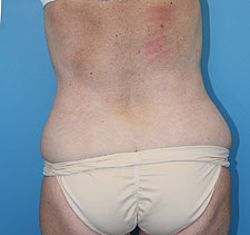 lipo After