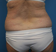 lipo after