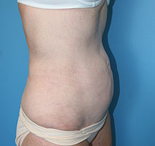 lipo Back
