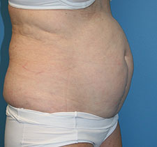 lipo before
