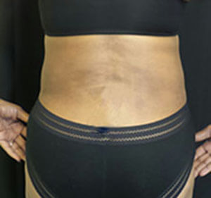 lipo After