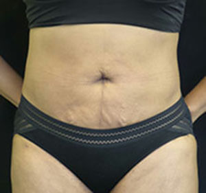 lipo Back