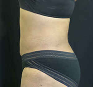 lipo After