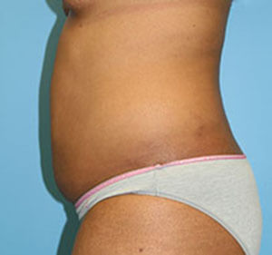 lipo before