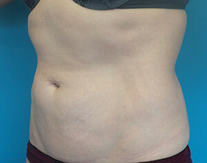 lipo Back