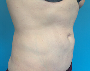 liposuction After