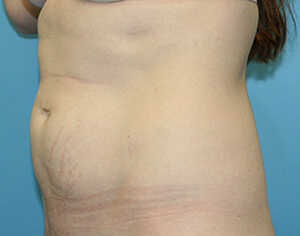 liposuction before