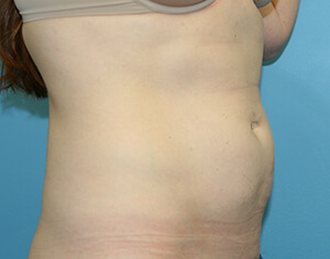 liposuction after