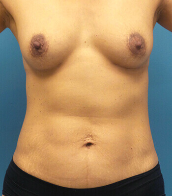 lipo Back