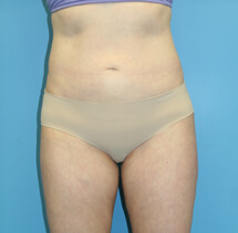 slimlipo after