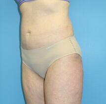 slimlipo after