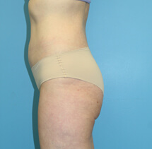 slimlipo after