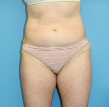 SlimLipo before