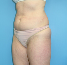 SlimLipo before