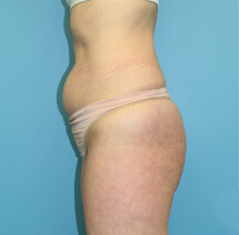 SlimLipo before