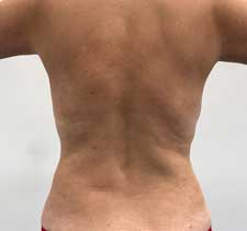 Back Liposuction after